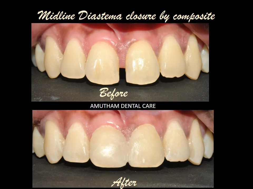 Composite Smile Design — before and after