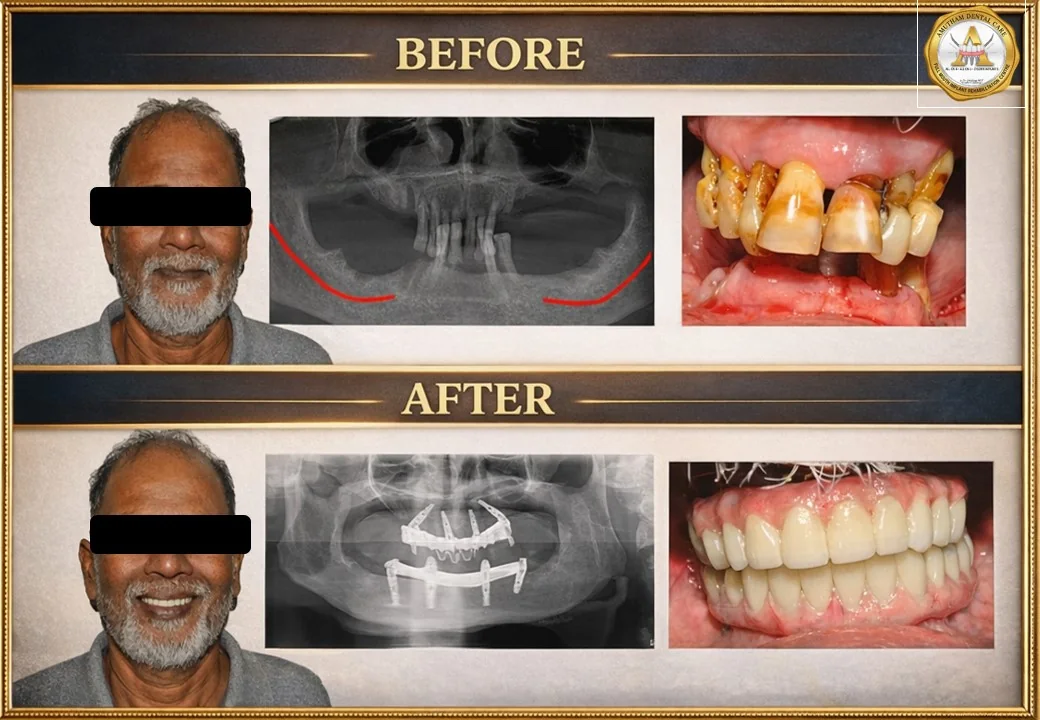 Full Mouth Implant Rehabilitation — before and after