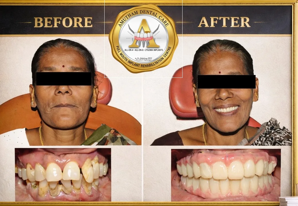 Full Mouth Implants — before and after