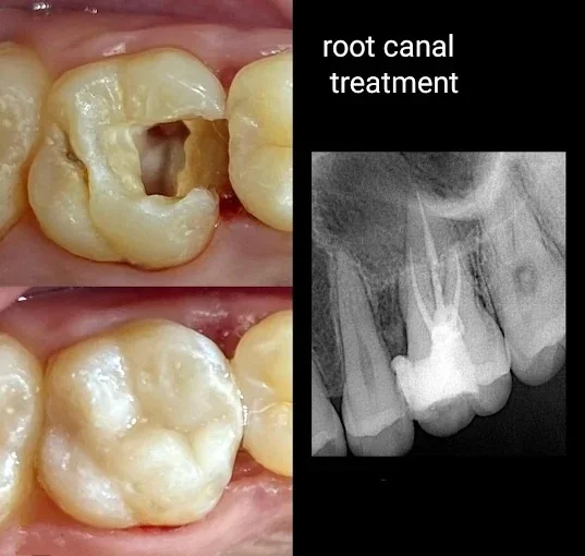 Root Canal Treatment — before and after