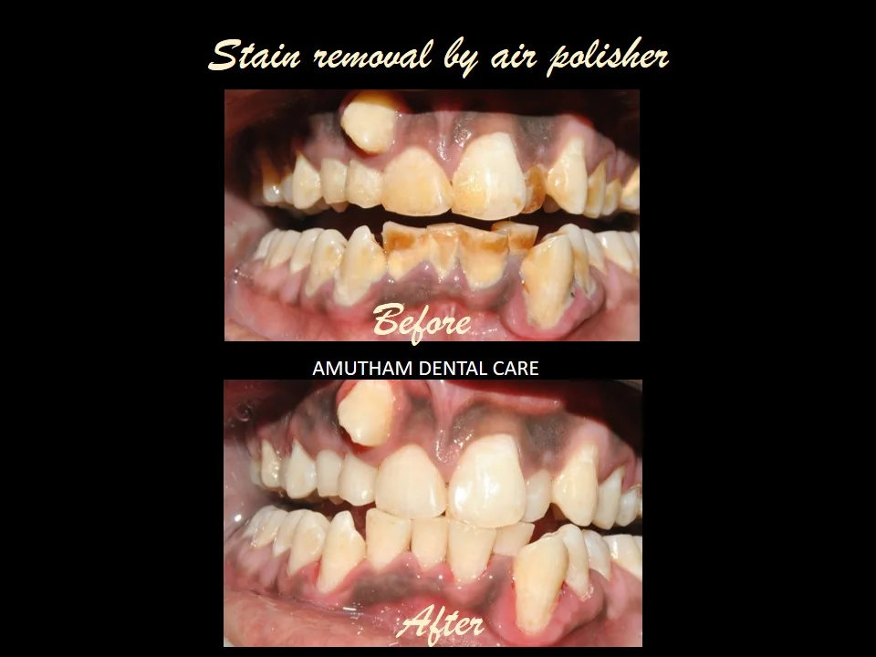 Stain Removal — Air Polishing — before and after