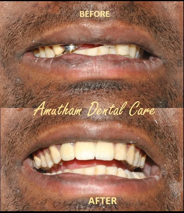 Zirconia Crowns — before and after